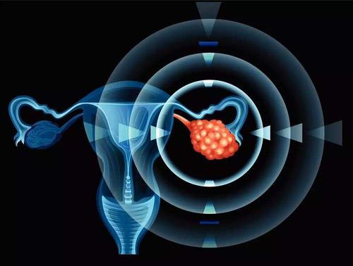 二次手术不能改善复发性卵巢癌患者的总体生存率