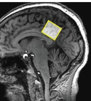 新的研究扫描了显示大脑区域的MRI