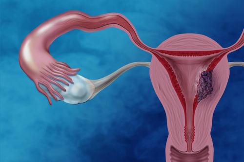 Mayo临床研究人员将绝经后视为子宫内膜癌的关键因素