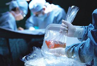 研究表明不完美的肾脏也可以成功用于移植