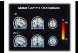 自闭症儿童的脑电活动变化
