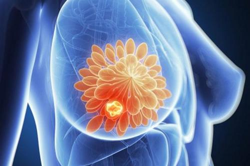 分子开关可能使乳腺癌对免疫治疗敏感