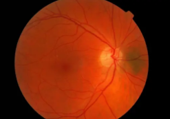 视网膜变薄是认知功能下降的早期迹象