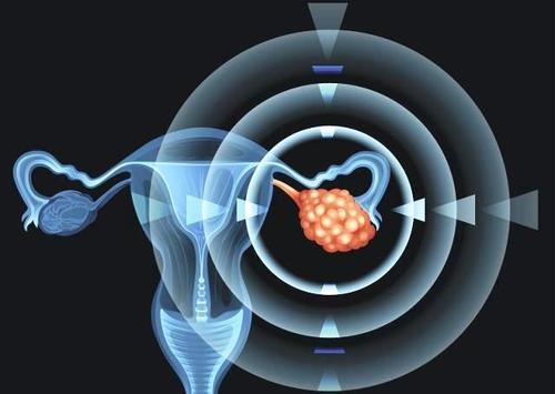 研究人员正在开发一种基于抗体的方法来摧毁致命的卵巢癌
