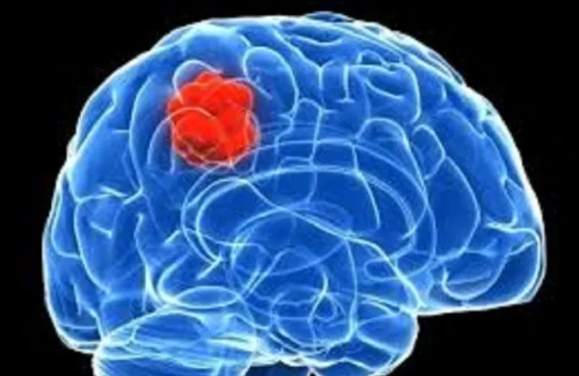 药物发现可能阻止脑癌扩散