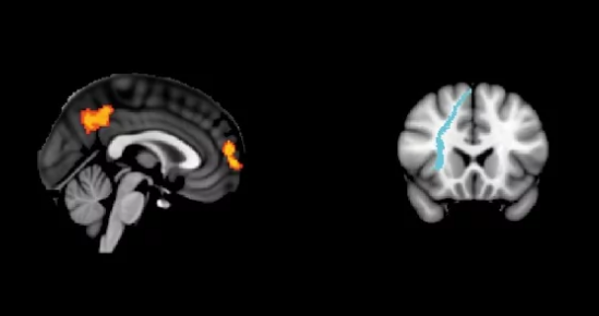 白色物质连接可能是成功刺激大脑的关键