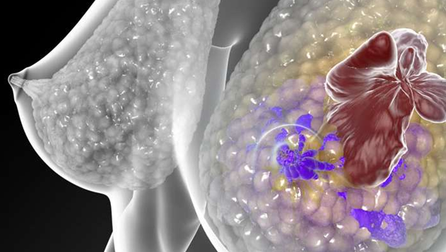 研究揭示了三阴性乳腺癌目标的新作用