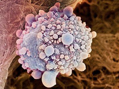 工程骨髓细胞减慢前列腺和胰腺癌细胞的生长