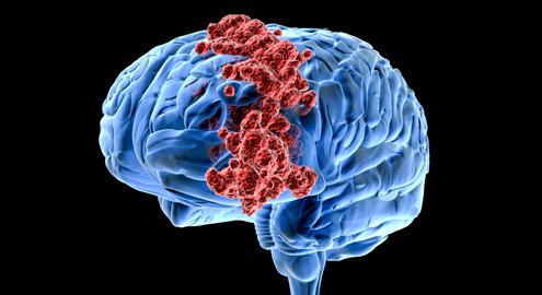 研究揭示了有关脑癌如何传播的新信息