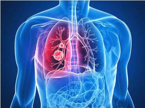 研究发现患者步数可以预测肺癌的治疗结果