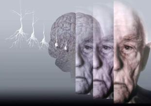 阿尔茨海默氏症的发作被证明是一个棘手的情况