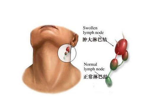 单药umbralisib对复发性慢生长淋巴瘤有效