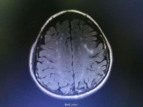 研究人员预测多发性硬化的严重程度