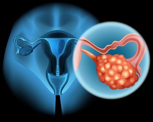 研究表明他汀类药物可降低卵巢癌风险