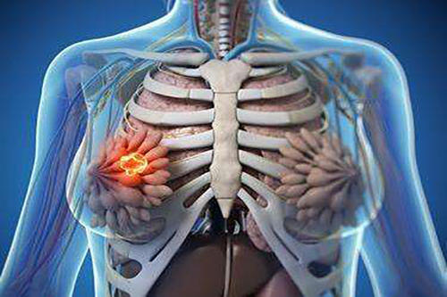 研究发现由辐射引起的炎症可导致三阴性乳腺癌