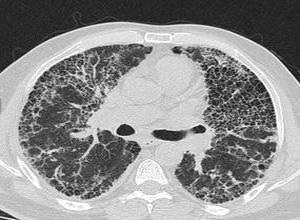 发现显示粘液积聚而不是感染如何引发囊性纤维化肺损伤