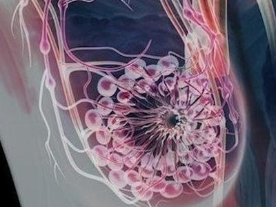 高浓度的IGF-1可能是导致乳腺癌的原因