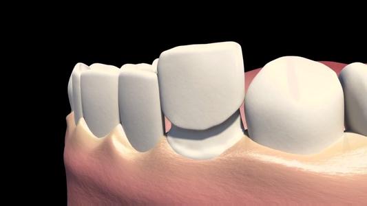 进一步的证据表明天然牙修复方法的临床可行性
