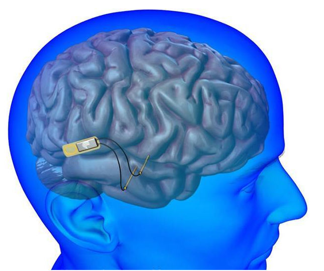 带有一千多个电极的下一代大脑植入物可以生存六年以上