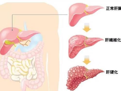 Obeticholic acid改善肝纤维化和NASH的其他组织学特征