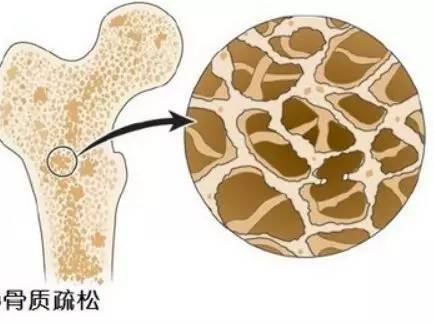 甲状旁腺激素复合物的近原子图指向骨质疏松症的新疗法