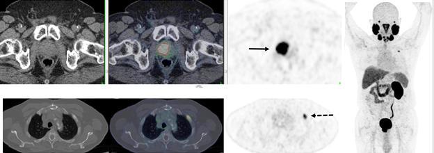 在复发性前列腺癌中 三分之二的病例采用PSMA PET CT改变治疗