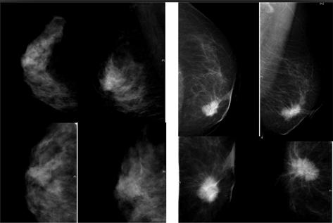 基于MR增强管理乳腺X线摄影的结构失真