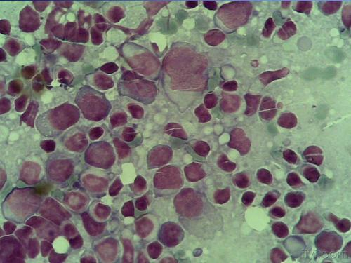 介绍下传染性单核细胞增多症的血象表现是什么