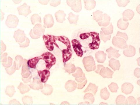 科普下血液学其他白细胞疾病及其诊断习题测试