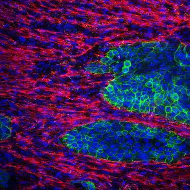 新的3D细胞培养模型可复制胰腺癌的纤维化成分