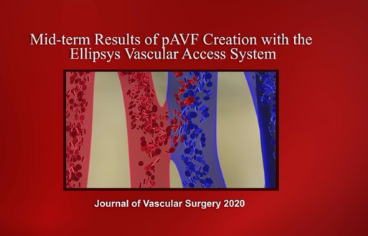 血管外科杂志上的大量研究为更广泛地使用经皮瘘管制作提供了路线图