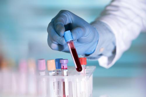 非侵入式血液检测可以在常规诊断方法之前四年检测出癌症