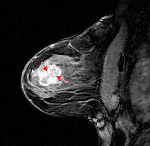 新辅助治疗中乳腺MRI新发可疑病变的频率和结果