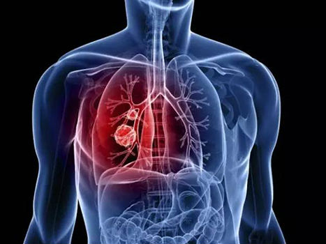 试验弥补了早期肺癌和乳腺癌治疗中的差异