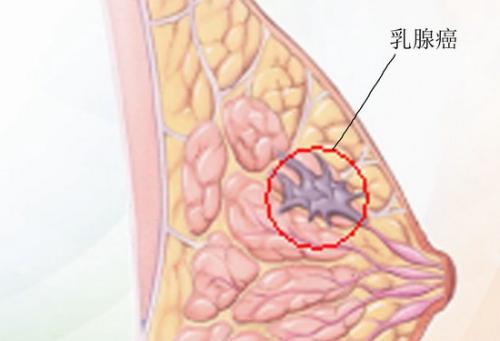 3D乳腺癌模型引入基质细胞作为新的药物治疗目标