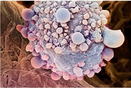 可切换的杀伤细胞在实验室中对胰腺癌细胞有效