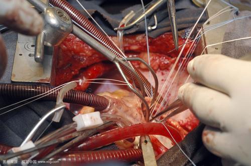 新技术降低了心脏瓣膜置换术中的阻塞风险