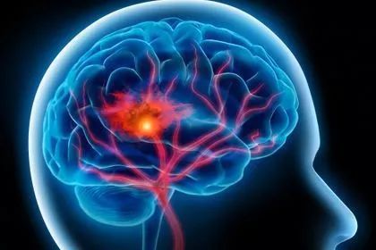 生物材料有助于脑卒中后脑组织再生