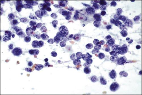 二甲双胍对非小细胞肺癌的NRG肿瘤学试验