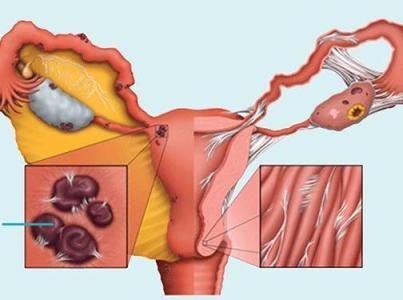 月经血中的干细胞可以帮助诊断子宫内膜异位症