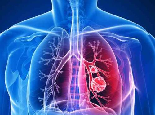 糖醛酸途径中的代谢中间体损害肺癌转移