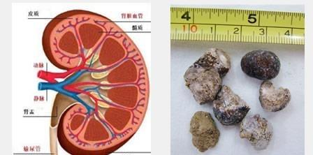 研究揭示了与肾结石相关的新遗传因素