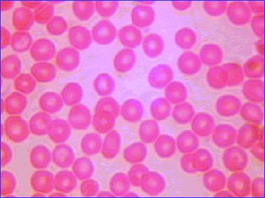 介绍下临床网织红细胞的分型有哪些