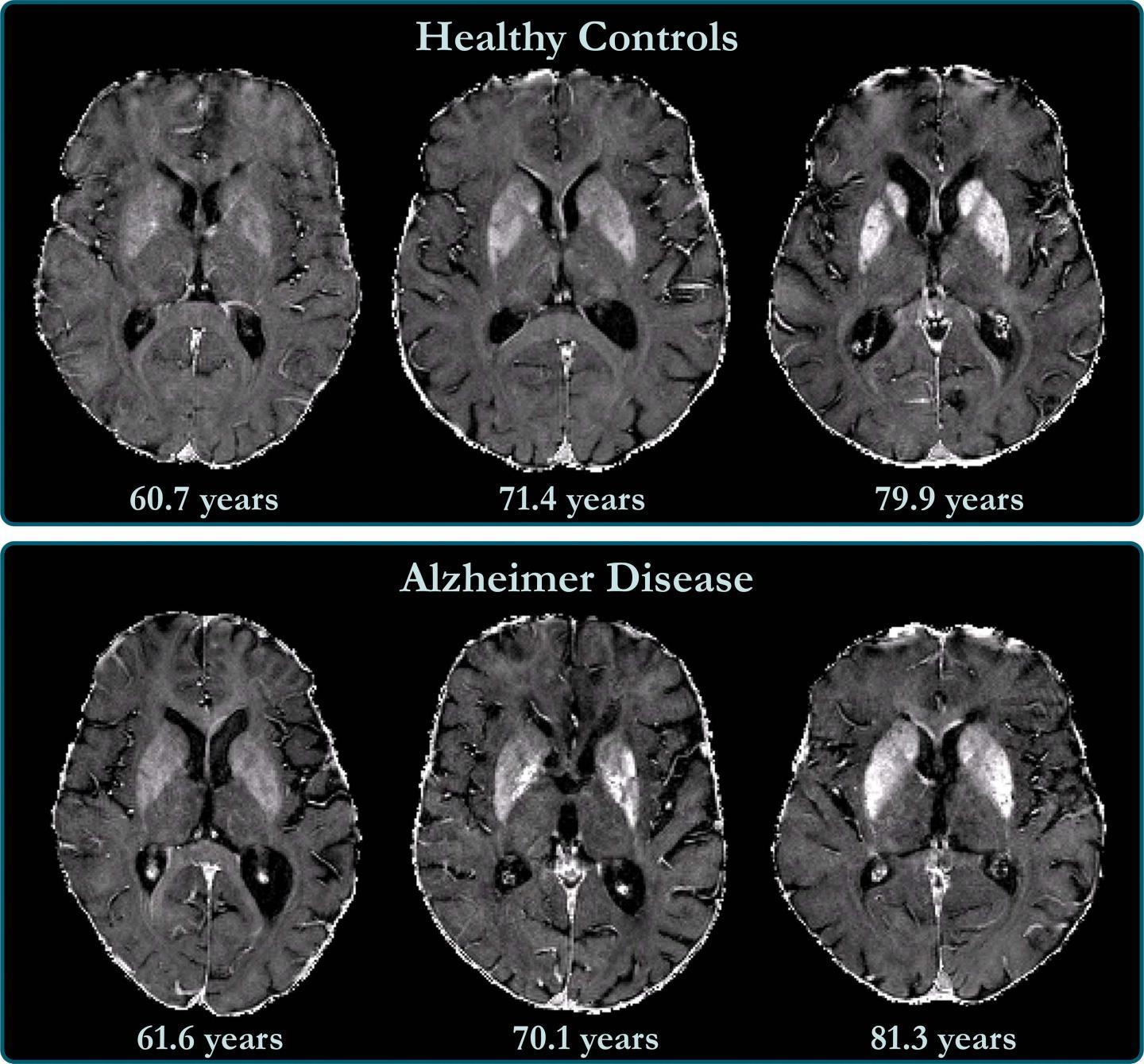 脑铁积聚与阿尔茨海默氏病患者的认知能力下降有关