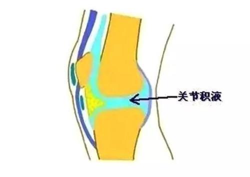 介绍下关节腔积液的化学检查是什么