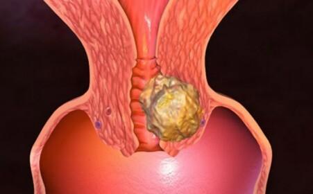 宫颈癌亚型在一些亚群中上升