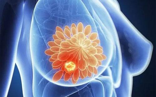 预防三阴性乳腺癌扩散