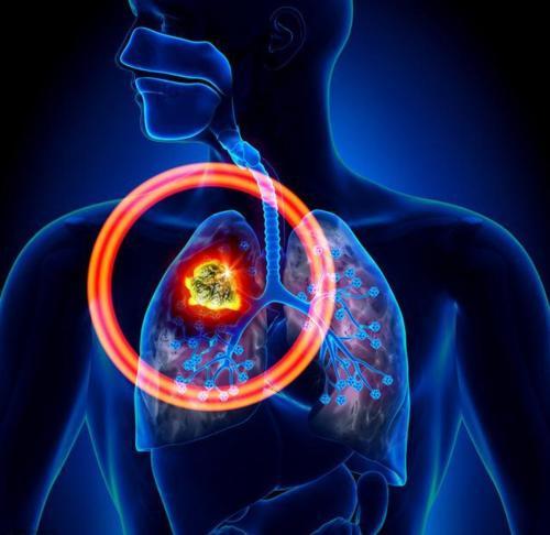 免疫抑制剂治疗并未证实对患者肺部疾病有负面影响