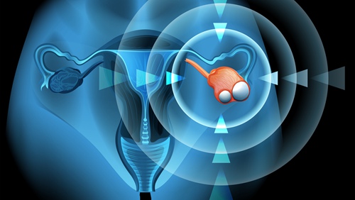 成像系统帮助外科医生去除微小的卵巢肿瘤