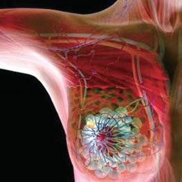 六种因素可预测DCIS诊断后浸润性乳腺癌复发